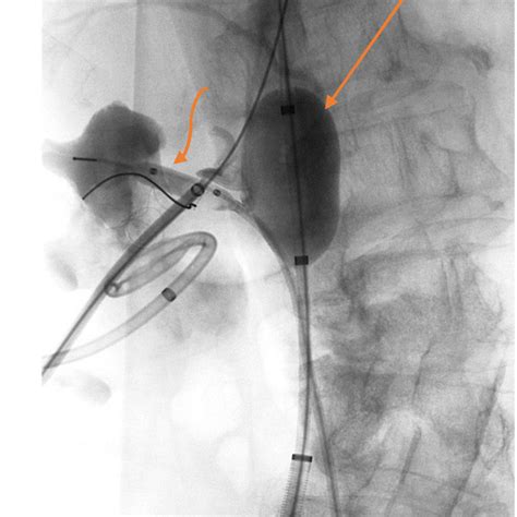 (PDF) The use of endo-vascular balloon tamponade technique for the ...