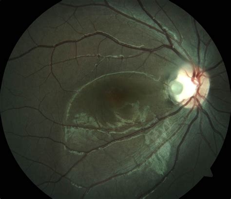 Optic Disc Pit - Retina Image Bank