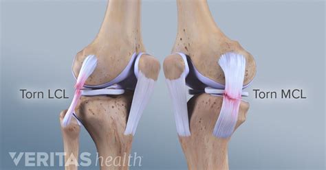 Lateral Collateral Ligament (LCL) Injuries | Knee ligament injury ...