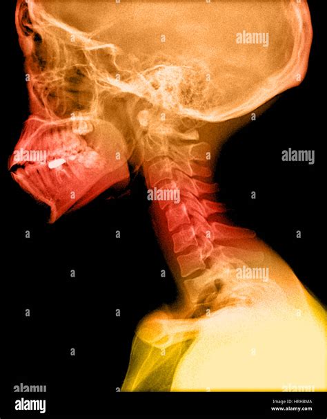 Human skull and cervical spine hi-res stock photography and images - Alamy