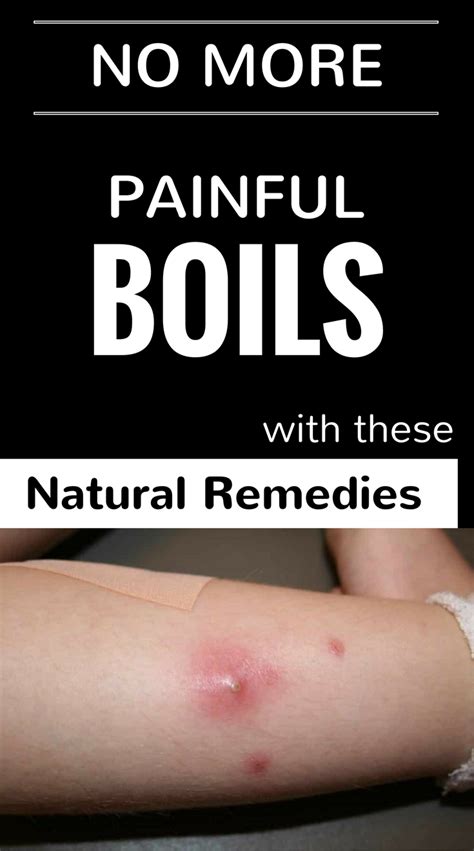 No More Painful Boils With These Natural Remedies | Get rid of boils ...