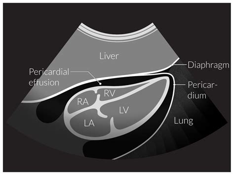 Pericardial Effusion Grading