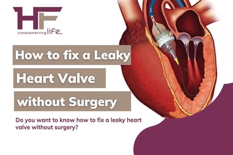 How To Fix A Leaky Heart Valve Without Surgery? - HealthFinder