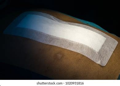 Laparotomy Images, Stock Photos & Vectors | Shutterstock