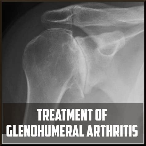 Treating Glenohumeral Osteoarthritis- Sports Medicine Review