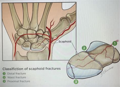 Scaphoid Fracture