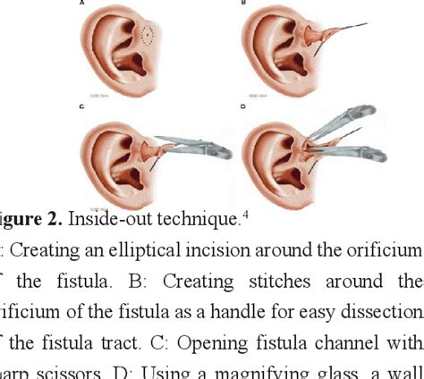 Figure 8 from Surgical management of preauricular fistula based on ...