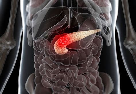 Best Practices to Screen for Pancreatic Cancer in High-Risk Individuals ...