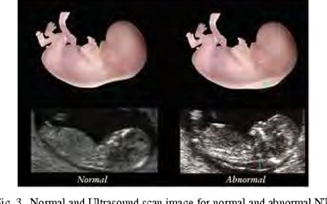 Ultrasound Picture Of Down Syndrome Baby - Captions Cute Today