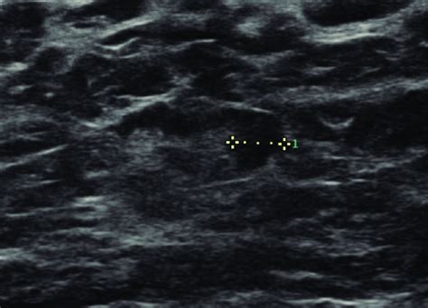 Ultrasound of an axillary lymph node with focal cortical thickening or... | Download Scientific ...