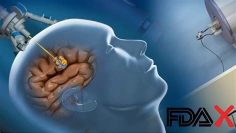 FDA revokes approval for brain surgery medical device due to heating ...