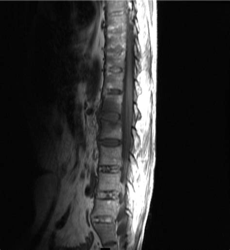 ANKYLOSING SPONDYLITIS-MRI - Sumer's Radiology Blog