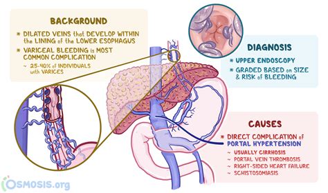 Esophageal Varices: What Are They, Causes | Osmosis