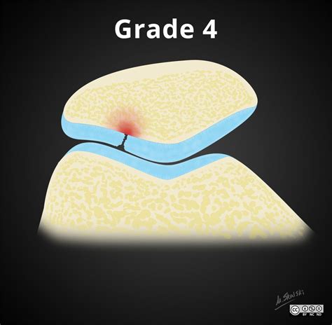 Viewing playlist: AAA-MARCH | Radiopaedia.org | Chondromalacia, Radiology, Medical illustration