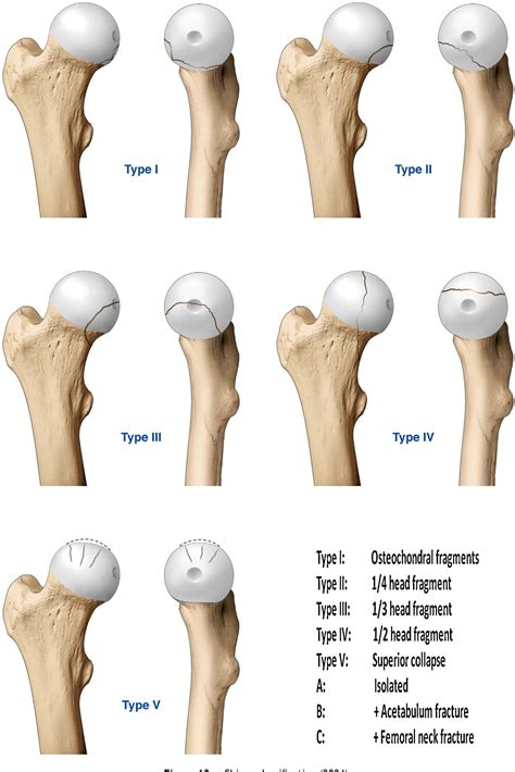 Figure 13 from Fracture-dislocations of the femoral head P . Chiron ...