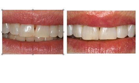 bleaching and direct resin fillings before and after | Elizabeth Caughey DDSElizabeth Caughey DDS