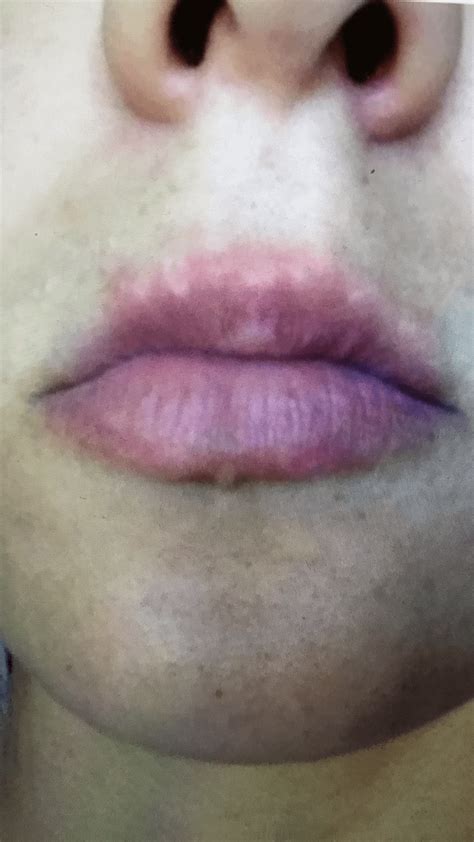 [Acne] Are acne scars on the lips fixable? : r/SkincareAddiction