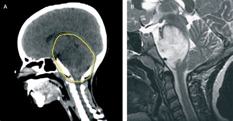 Diffuse brainstem glioma in children: critical review of clinical trials - The Lancet Oncology