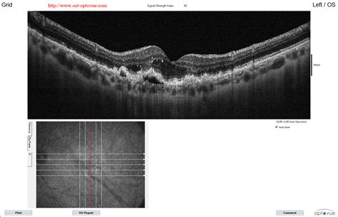 OCT angiography & ARMD