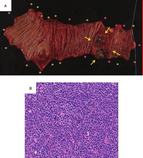 A, Photograph of the surgical specimen in the terminal ileum and B,... | Download Scientific Diagram