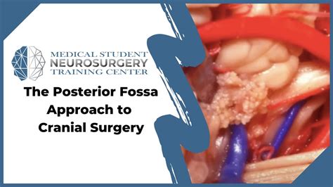 The Posterior Fossa Approach to Cranial Surgery - YouTube