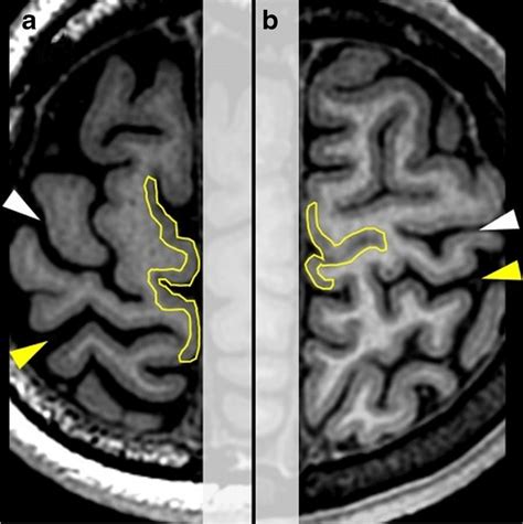 Misidentification of the central sulcus. On both (a) and (b), the... | Download Scientific Diagram