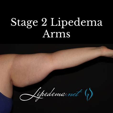 Learn About Stages and Types of Lipedema | Lipedema.net