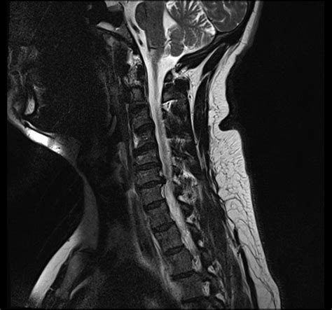 Cervical Radiculopathy – John Snyder, DPT