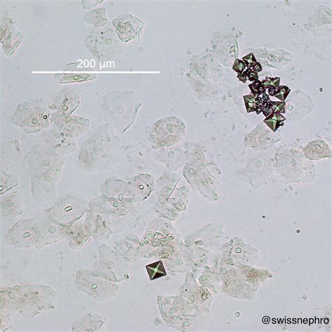 Urine Sediment of the Month: Common Crystals! - Renal Fellow Network