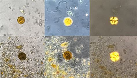 Bubbles In Pee Kidney Stones at David Kinder blog