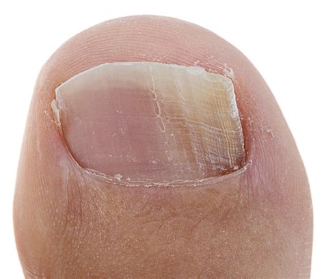 Really Bad Toenail Fungus: [Causes, Home Remedies & Best Treatment!]