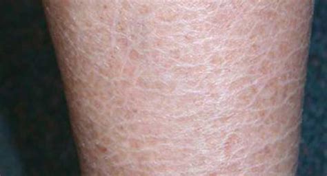 Ichthyosis Vulgaris: Causes, Symptoms, and Diagnosis