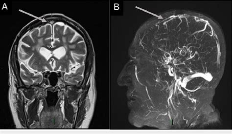 Superior sagittal sinus thrombosis in a 75-year-old male who was RT-PCR... | Download Scientific ...