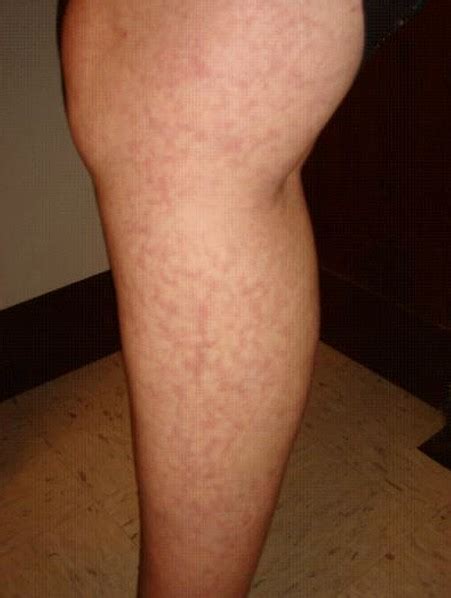 Livedo Reticularis - Pictures, Symptoms, Diagnosis, Causes, Treatment