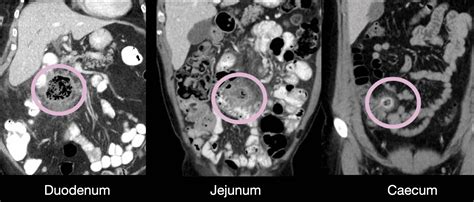 Abdominal CT: diverticulitis • LITFL • Radiology Library