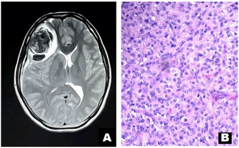 Diffused astrocytoma grade 2. (A) An axial cut of MRI brain with... | Download Scientific Diagram