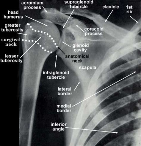 Physical Therapists Help You Heal from Your Shoulder Fracture - Best Physical Therapist NYC | 29 ...