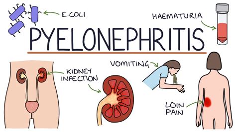 Understanding Pyelonephritis (Kidney Infections) - YouTube