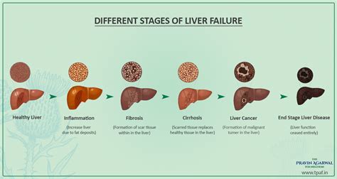 Figure From Chronic Liver Disease Staging Classification Based On | My ...