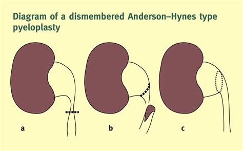 Hydronephrosis in children: pelviureteric junction dysfunction ...