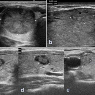 EU-TIRADS 4; A: Moderately heterogenous nodule with isoechoic and... | Download Scientific Diagram