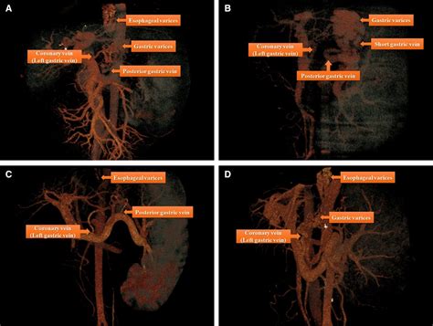 Coronary Vein Portal Hypertension