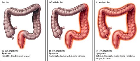 Ulcerative colitis - The Lancet