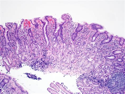 Pathology Outlines - Helicobacter pylori