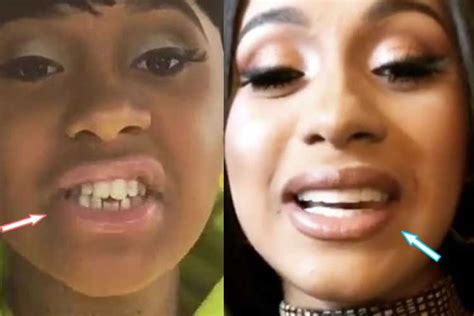 Cardi b teeth before and after: cost, surgery, pictures