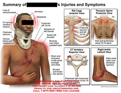 AMICUS Illustration of amicus,injury,symptoms,consciousness,C7,cervical ...