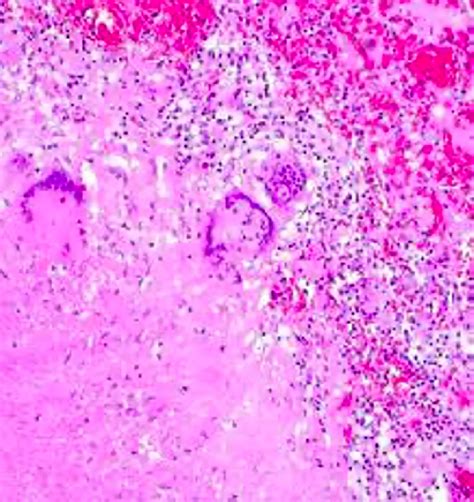 Granulomatous inflammation. | Download Scientific Diagram