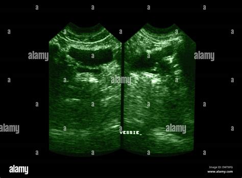 Bladder ultrasound scan Stock Photo - Alamy