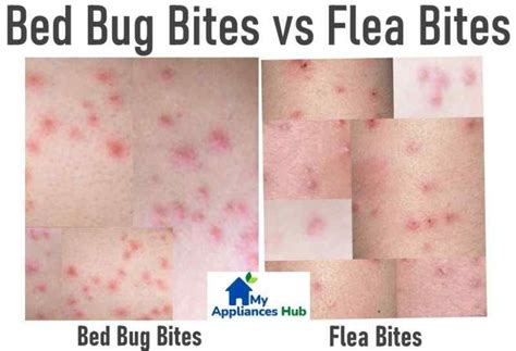 Bed Bug Bites vs Flea Bites: How to Tell the Difference and Get Relief ...