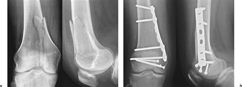 Distal Femur Fractures | Musculoskeletal Key